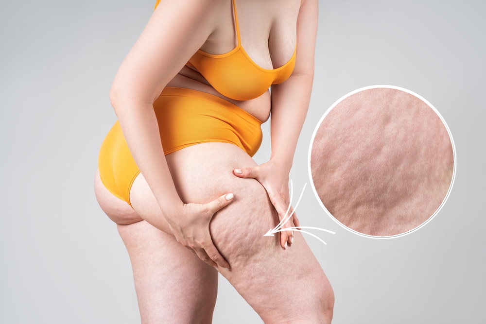 Atendimento nutricional para lipedema